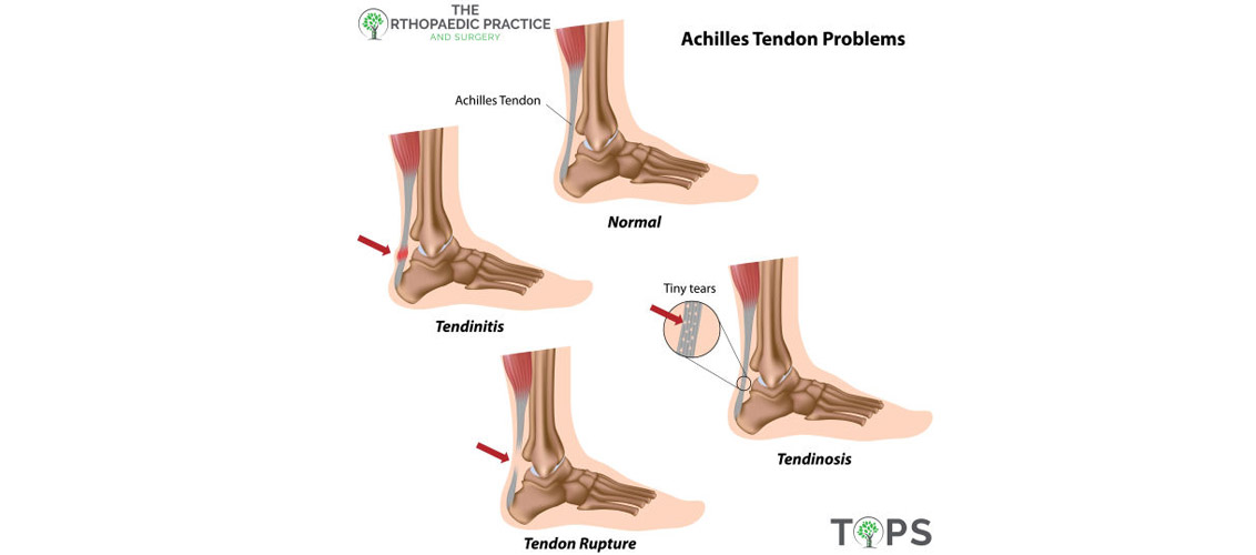 Achilles Tendinitis – What You Need To Know