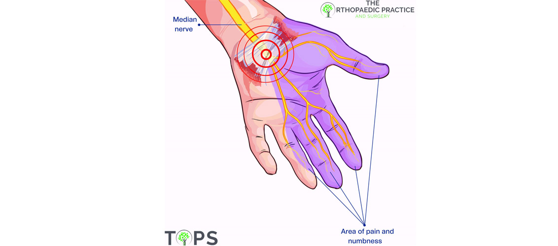 Carpal tunnel syndrome – What You Need To Know