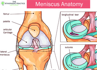 Meniscus Injury